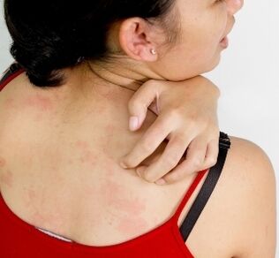 granulomi na tijelu - simptomi prisutnosti parazita