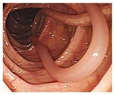 parazita u ljudskom tijelu
