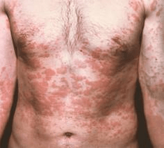 problematična koža je simptom prisutnosti parazita